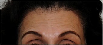 Botox before 66933
