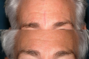 Fraxel re:store treatment for scar before 409088