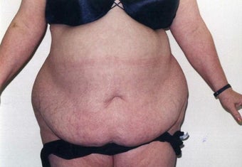 Tummy Tuck before 215129