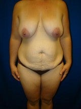 Breast Reduction, Tummy Tuck (Abdominoplasty), Mommy Makeover before 404137
