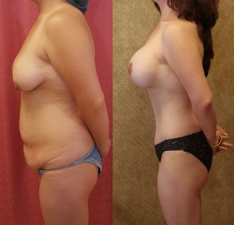 Tummy tuck with breast lift after 587843
