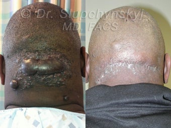 Keloid Removal before 565736