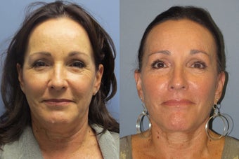 Lite Lift, Liposuction of the neck before 523449