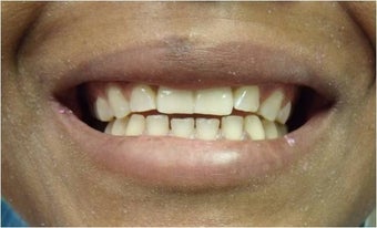 Mini Dental Implants replacing missing front teeth after 402361