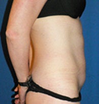 Mini-Abdominoplasty with VASER liposuction before 384685
