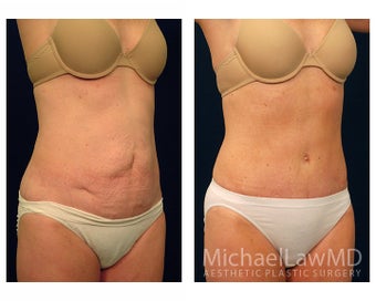 Abdominoplasty - Tummy Tuck after 396132