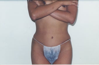 Tummy Tuck after 213142