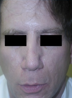 Silicone Microdroplet Therapy for Acne Scars after 334060