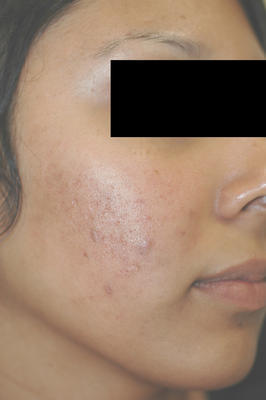 Laser Acne Treatment after 82974
