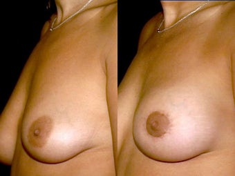 Breast augmentation and mastopexy (breast lift and implants) before 610380