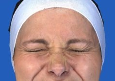 Botox Crow's Feet before 469033