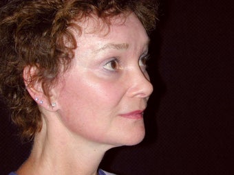 Facelift, Endoscopic Browlift, upper blephroplasty after 240022