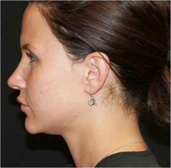Ultherapy before 434702