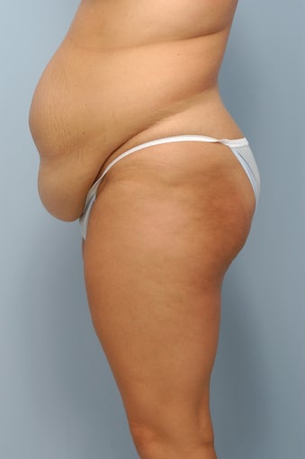 Tummy Tuck before 367308