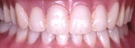 Dental Implants after 510566