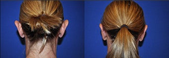 Otoplasty before 633519