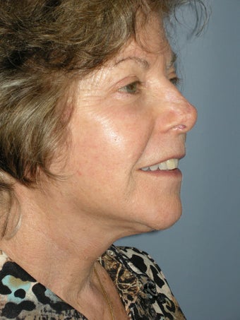 Obagi Blue Peel 635073