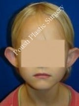 Ear Surgery (Otoplasty) before 579109