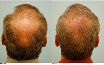 Crown (Vertex) Hair Transplant before 134776