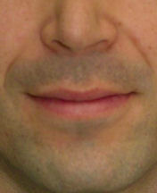 Lip Lift before 635462