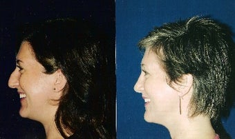 Rhinoplasty and Septoplasty before 241677