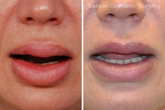 Lip Reduction and Repair 485284