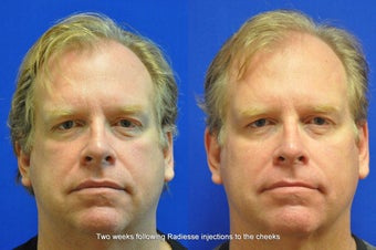 Radiesse Injection in Cheeks before 403466