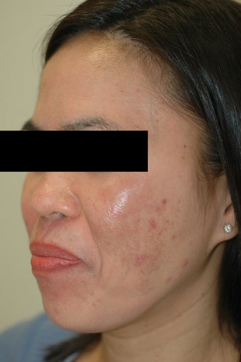 Melasma Treatment Before and After Photos after 641757