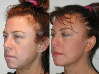 Minifacelift Blepharoplasty before 137755