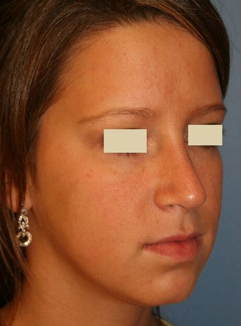 Rhinoplasty after 142566