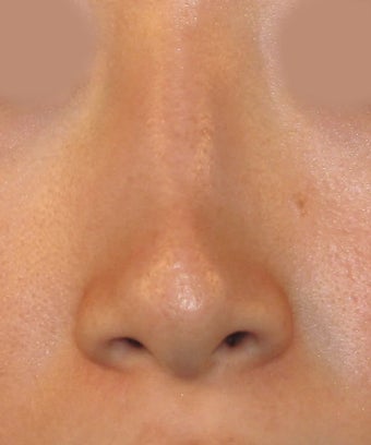 Revision Rhinoplasty before 410604