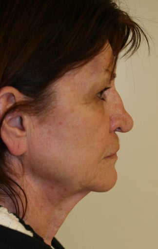 Facelift and Rhinoplasty before 216690