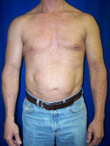 Pec Implants before 130083