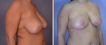 Breast Reduction & Lift before 270051