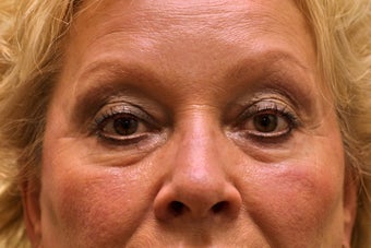 Upper & Lower Blepharoplasty with Fat Repositioning before 104061