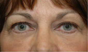 Lower blepharoplasty and fat grafting after 524914