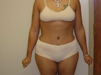 Tummy Tuck after 504649