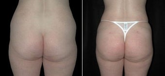 Buttock Augmentation before 110101