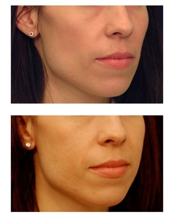 Cheek Augmentation 347496
