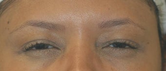 Botox Treatment after 93600
