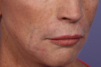 Radiesse and Juvederm - Smile lines 309227