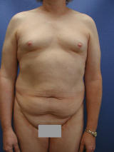Male breast augmentation and tummy tuck before 106845