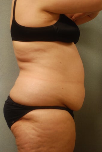 SmartLipo Complete Wrap around before 346597
