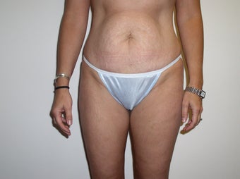 Mini Abdominoplasty before 374416