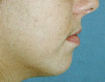 Chin Augmentation before 251515