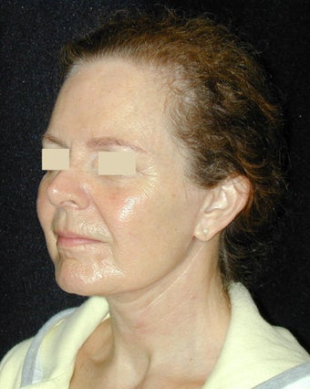Facelift / Necklift after 103851