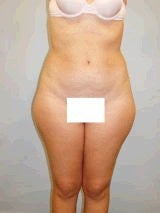 Liposuction Surgery before 143956