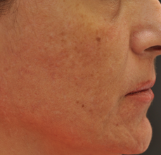 Acne Scarring 426030