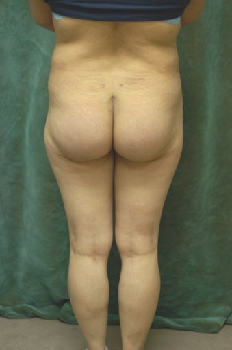 Women's Buttocks Augmentation 518113