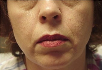 Juvederm before 481437